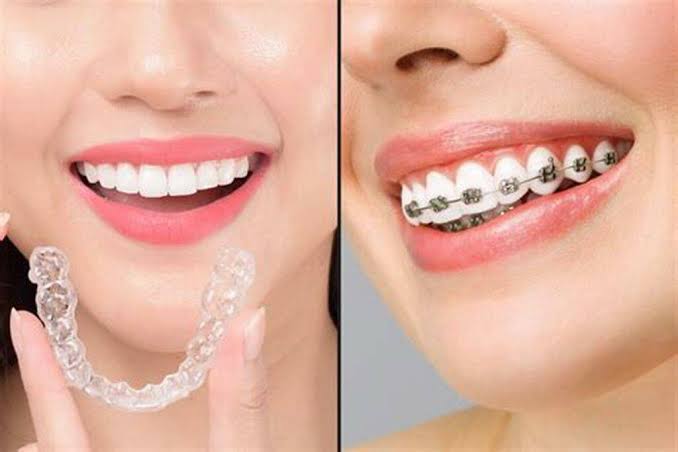 Braces & Invisalign