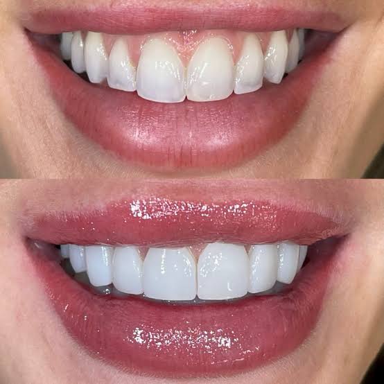 Crowns, Bridges & Veneers